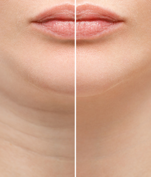 lipo-de-papada-clinica-anastasia.png